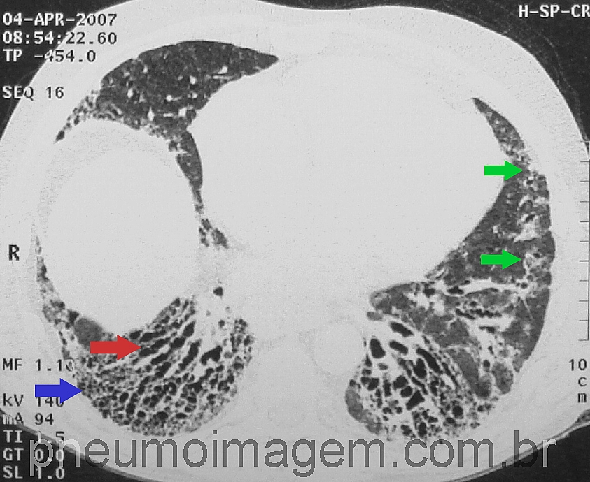 DESTAQUES DO ERS2016: FIBROSE PULMONAR IDIOP�TICA ASSOCIADA AO ENFISEMA PULMONAR